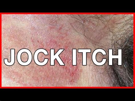It belongs to a group of fungal skin infections called tinea. . Jock itch healing stages pictures